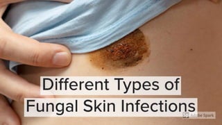 Different types of ringworm - Ring Out