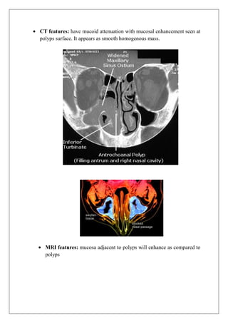 CT features: have mucoid attenuation with mucosal enhancement seen at
polyps surface. It appears as smooth homogenous mass.
MRI features: mucosa adjacent to polyps will enhance as compared to
polyps
 