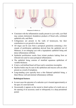 Pathogenesis of radicular cyst
Consistent with the inflammation usually present in cyst walls, cyst fluid
may contain cholesterol, breakdown products of blood cells, exfoliated
epithelial cells, and fibrin.
Collagenases are present in the walls of keratocysts, but their
contribution to cyst growth is also unclear.
All stages can be seen from a periapical granuloma containing a few
strands of proliferation epithelium derived from the epithelial rest of
Malassez, to an enlarging cyst with a hyperplastic epithelial lining and
dense inflammatory infiltrate.
Epithelial proliferation results from irritant products leaking from an
infected root canal to cause periapical inflammation.
The epithelial lining consists of stratified squamous epithelium of
variable thickness.
It lack a well-defined basal cell layer and is sometimes incomplete.
Hyaline bodies may be seen in the epithelium and mucous cells are often
present as a result of metaplasia.
Long-standing cysts typically have a thin flattened epithelial lining, a
thick fibrous wall and minimal inflammatory infiltrate
Radiological features
In most cases the epicenter of a radicular cyst is located approximately at
the apex of a nonvital tooth
Occasionally it appears on the mesial or distal surface of a tooth root, at
the opening of an accessory canal or infrequently in a deep periodontal
pocket
 