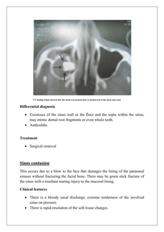CT finding which showed that the tooth was located close to mesial wall of the sinus and roots
Differential diagnosis
Exostoses of the sinus wall or the floor and the septa within the sinus,
may mimic dental root fragments or even whole teeth.
Anthroliths
Treatment
Surgical removal
Sinus contusion
This occurs due to a blow to the face that damages the lining of the paranasal
sinuses without fracturing the facial bone. There may be green stick fracture of
the sinus with a resultant tearing injury to the mucosal lining.
Clinical features
There is a bloody nasal discharge, extreme tenderness of the involved
sinus on pressure.
There is rapid resolution of the soft tissue changes.
 