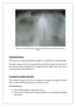 CORONAL SECTION TOMOGRAPH OF PATIENT WITH BLOW OUT FRACTURE OF RIGHT ORBITAL
FLOOR
Isolated fracture
This involves a single wall which may appear as a bright line on the radiograph.
The most common sites are the anterolateral wall of the antrum and the floor of
the antrum, during extraction of the upper posterior teeth whose roots are in
close proximity to the antrall floor.
Zygomatic complex fracture
This fractures occurs at the line of weakness and passes through the orbital
floor, usually medial to the zygomaticomaxillary suture.
Clinical features
The fractured zygoma is forced into sinus.
There may be tearing of the lining membrane with subsequent bleeding
into antrum.
 