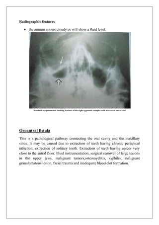 Radiographic features
the antrum appers cloudy or will show a fluid level.
Standard occipitomental showing fracture of the right zygomatic complex with a break of antral roof
Oroantral fistula
This is a pathological pathway connecting the oral cavity and the maxillary
sinus. It may be caused due to extraction of teeth having chronic periapical
infection, extraction of solitary tooth. Extraction of teeth having apices very
close to the antral floor, blind instrumentation, surgical removal of large lesions
in the upper jaws, malignant tumors,osteomyelitis, syphilis, malignant
granulomatous lesion, facial trauma and inadequate blood clot formation.
 