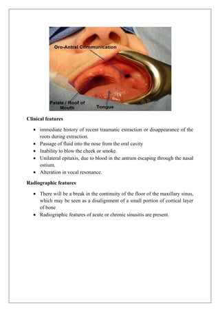Clinical features
immediate history of recent traumatic extraction or disappearance of the
roots during extraction.
Passage of fluid into the nose from the oral cavity
Inability to blow the cheek or smoke.
Unilateral epitaxis, due to blood in the antrum escaping through the nasal
ostium.
Alteration in vocal resonance.
Radiographic features
There will be a break in the continuity of the floor of the maxillary sinus,
which may be seen as a disalignment of a small portion of cortical layer
of bone
Radiographic features of acute or chronic sinusitis are present.
 