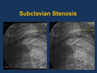 Subclavian Stenosis
 