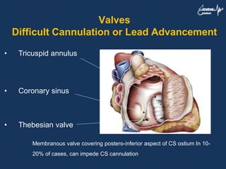 • Tricuspid annulus
• Coronary sinus
• Thebesian valve
Membranous valve covering postero-inferior aspect of CS ostium In 10-
20% of cases, can impede CS cannulation
Valves
Difficult Cannulation or Lead Advancement
 