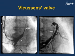 Vieussens’ valve
 