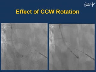 Effect of CCW Rotation
 
