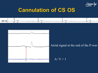 Cannulation of CS OS
IEGM to confirm position
A/ V > 1
Atrial signal at the end of the P-wav
 