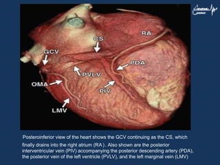 Posteroinferior view of the heart shows the GCV continuing as the CS, which
finally drains into the right atrium (RA). Also shown are the posterior
interventricular vein (PIV) accompanying the posterior descending artery (PDA),
the posterior vein of the left ventricle (PVLV), and the left marginal vein (LMV)
 