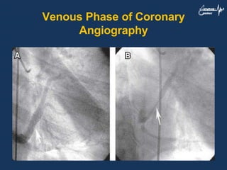 Venous Phase of Coronary
Angiography
 