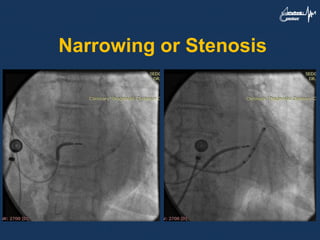 Narrowing or Stenosis
 