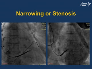 Narrowing or Stenosis
 