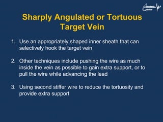 Sharply Angulated or Tortuous
Target Vein
1. Use an appropriately shaped inner sheath that can
selectively hook the target vein
2. Other techniques include pushing the wire as much
inside the vein as possible to gain extra support, or to
pull the wire while advancing the lead
3. Using second stiffer wire to reduce the tortuosity and
provide extra support
 