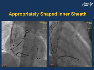 Appropriately Shaped Inner Sheath
 