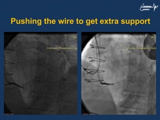 Pushing the wire to get extra support
 