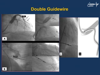 Double Guidewire
 