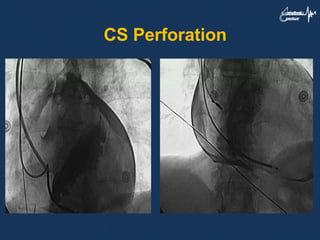 CS Perforation
 