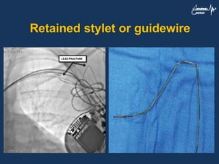Retained stylet or guidewire
 