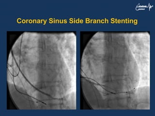Coronary Sinus Side Branch Stenting
 