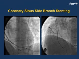 Coronary Sinus Side Branch Stenting
 