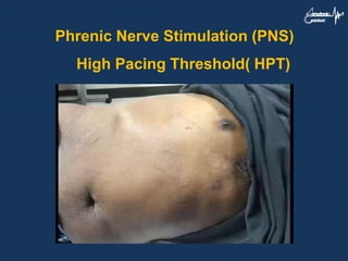 Phrenic Nerve Stimulation (PNS)
High Pacing Threshold( HPT)
 