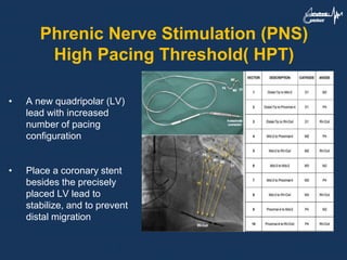 Phrenic Nerve Stimulation (PNS)
High Pacing Threshold( HPT)
• A new quadripolar (LV)
lead with increased
number of pacing
configuration
• Place a coronary stent
besides the precisely
placed LV lead to
stabilize, and to prevent
distal migration
 