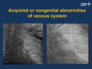 Acquired or congenital abnormities
of venous system
 