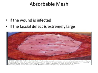 Absorbable Mesh
• If the wound is infected
• If the fascial defect is extremely large
 