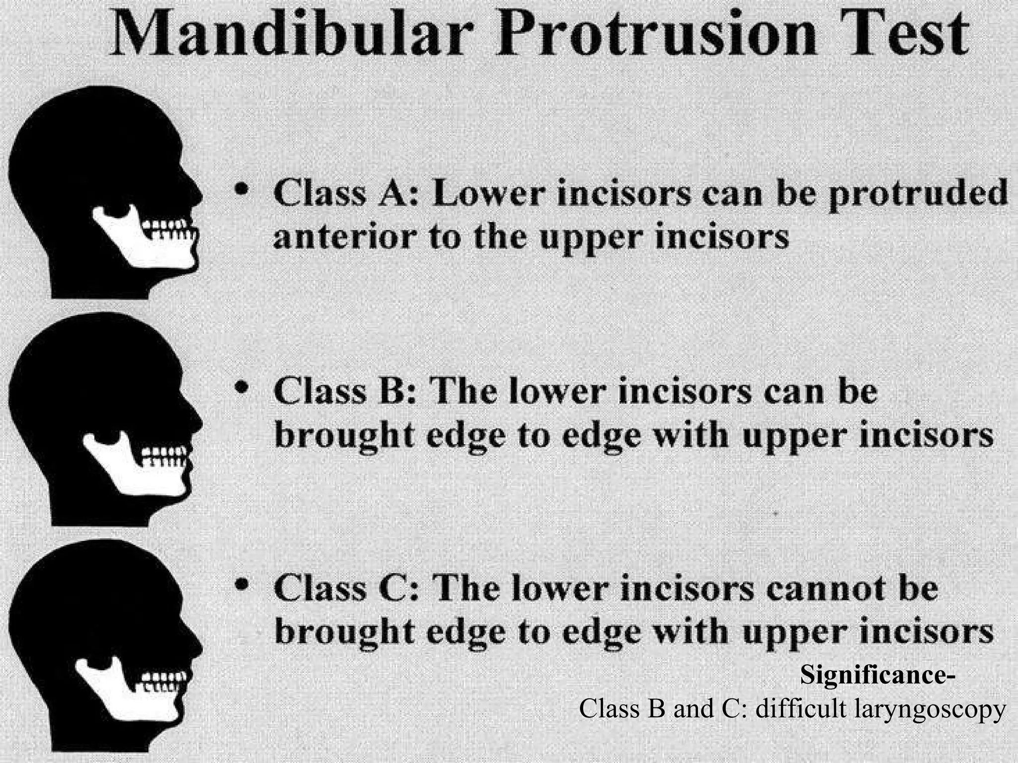 Significance- Class B and C: difficult laryngoscopy 