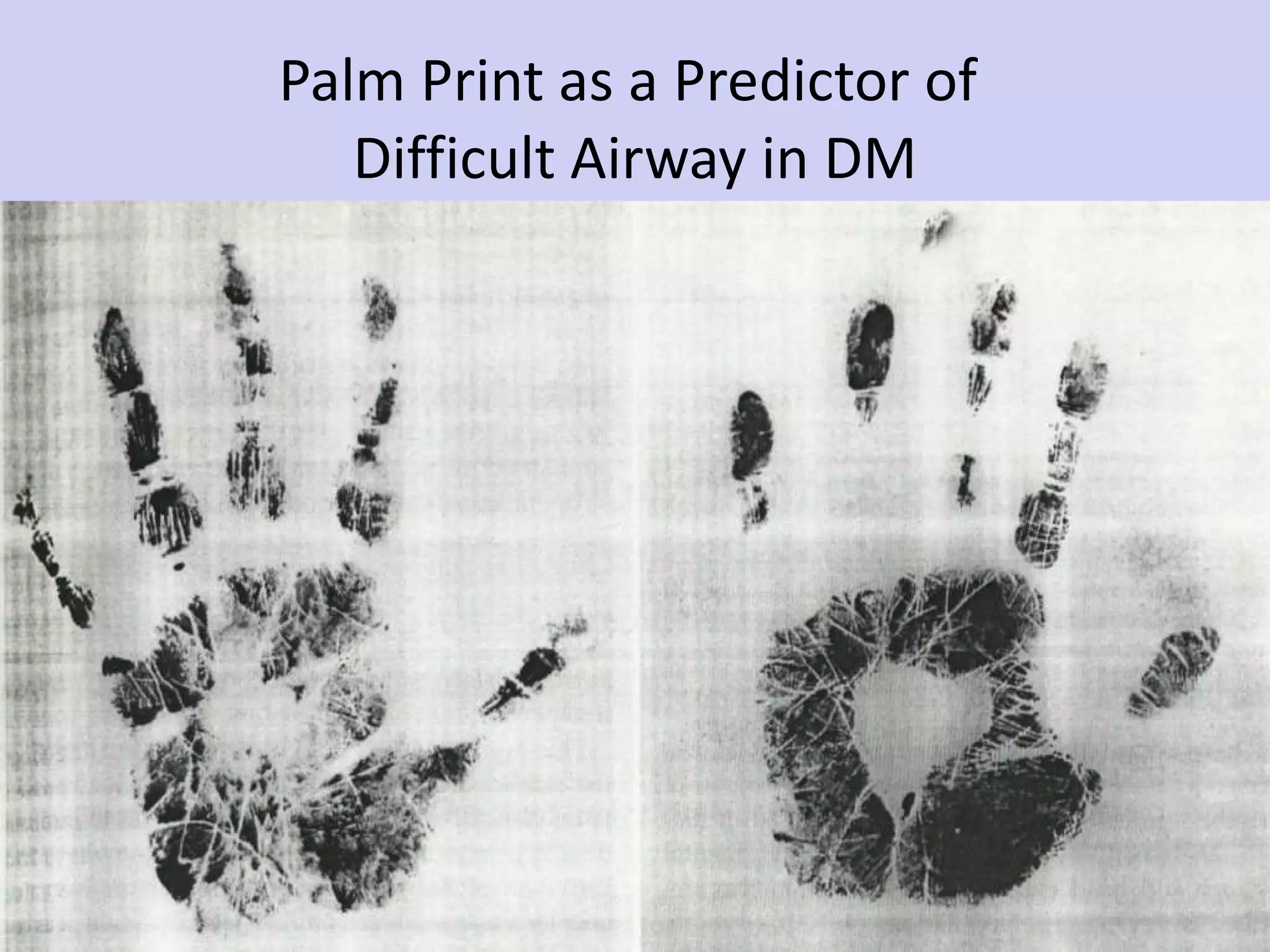 Palm Print as a Predictor of  Difficult Airway in DM 