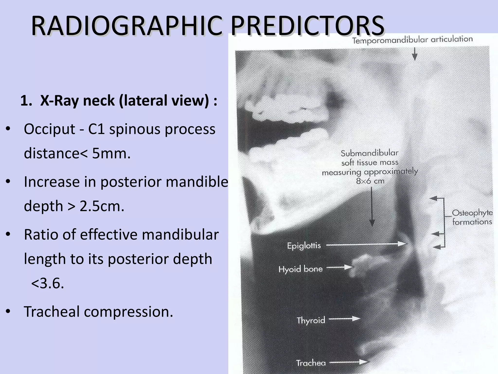 1.  X-Ray neck (lateral view) : Occiput - C1 spinous process  distance< 5mm. Increase in posterior mandible  depth > 2.5cm. Ratio of effective mandibular  length to its posterior depth  <3.6. Tracheal compression.  RADIOGRAPHIC PREDICTORS 