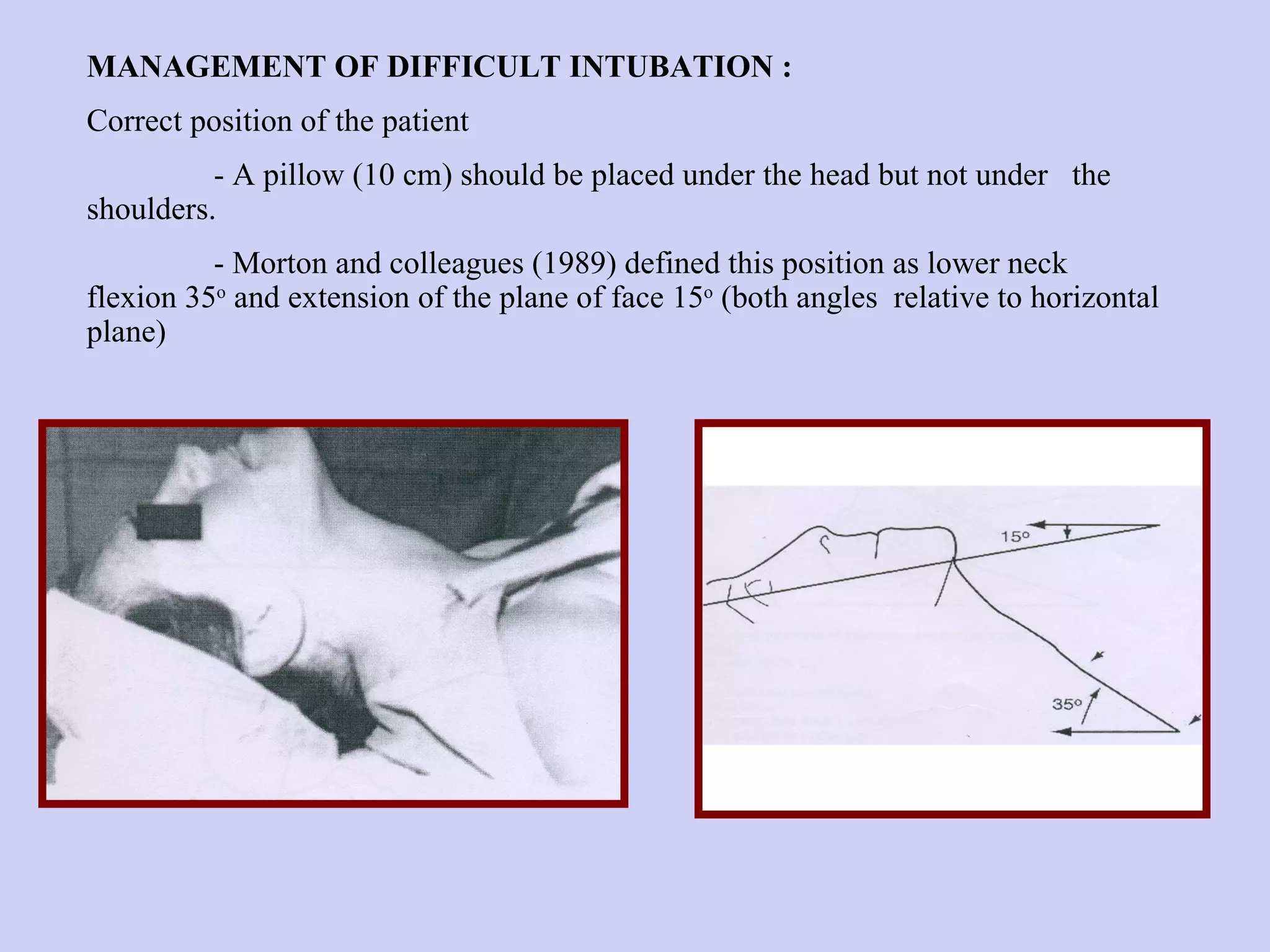 MANAGEMENT OF DIFFICULT INTUBATION : Correct position of the patient  - A pillow (10 cm) should be placed under the head but not under  the shoulders. - Morton and colleagues (1989) defined this position as lower neck    flexion 35 o  and extension of the plane of face 15 o  (both angles  relative to horizontal plane) 