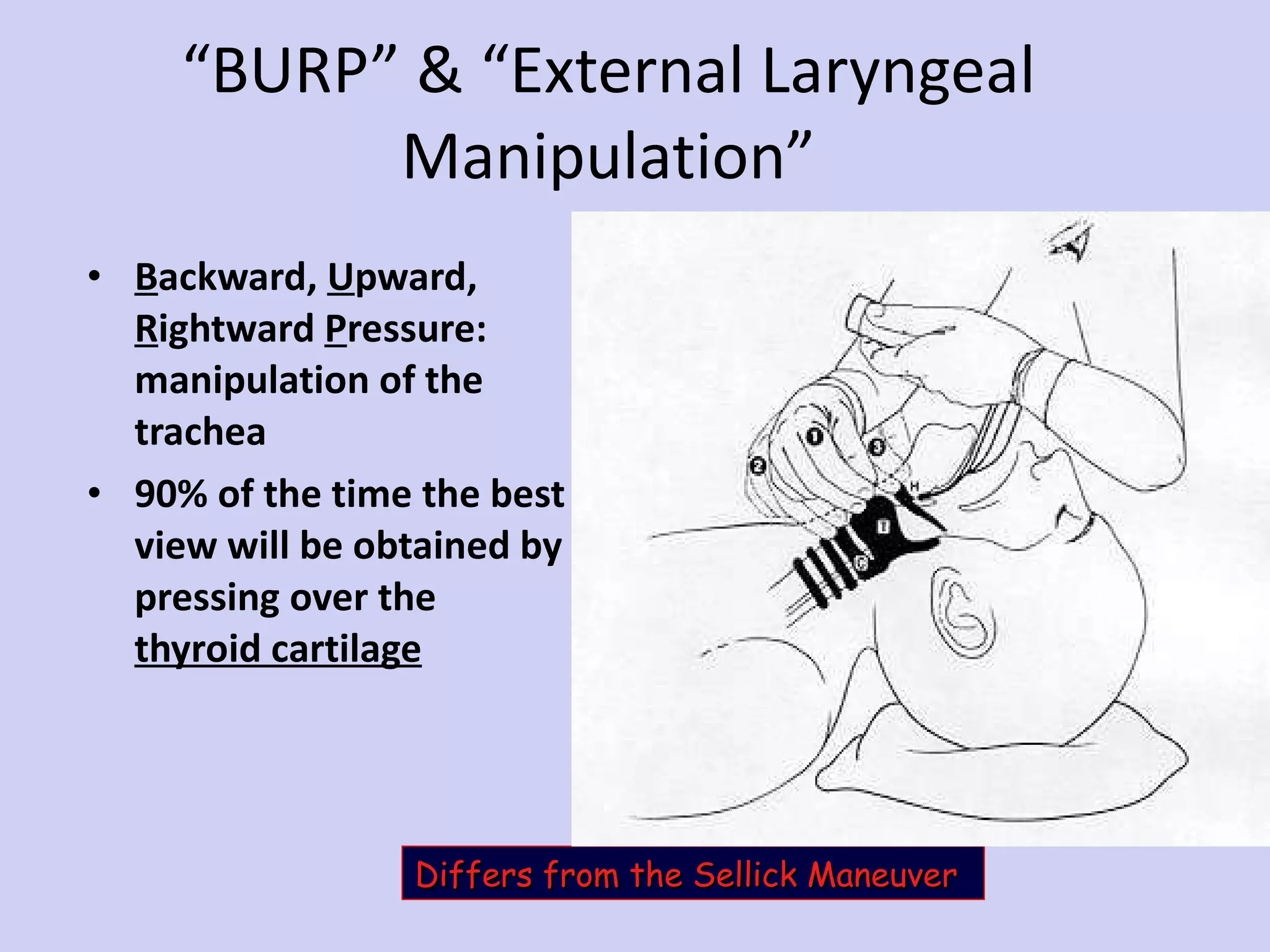 “ BURP” & “External Laryngeal Manipulation” B ackward,  U pward,  R ightward  P ressure: manipulation of the trachea 90% of the time the best view will be obtained by pressing over the  thyroid cartilage Differs from the Sellick Maneuver 