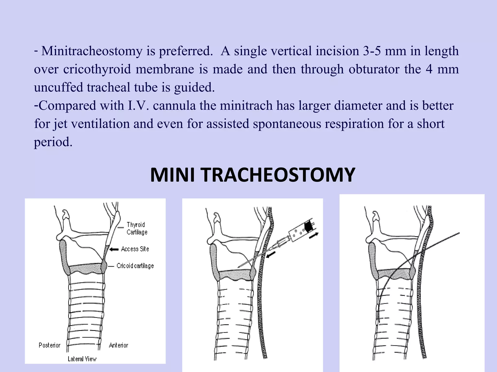 Minitracheostomy is preferred.  A single vertical incision 3-5 mm in length over cricothyroid membrane is made and then through obturator the 4 mm uncuffed tracheal tube is guided.  Compared with I.V. cannula the minitrach has larger diameter and is better for jet ventilation and even for assisted spontaneous respiration for a short period. MINI TRACHEOSTOMY 