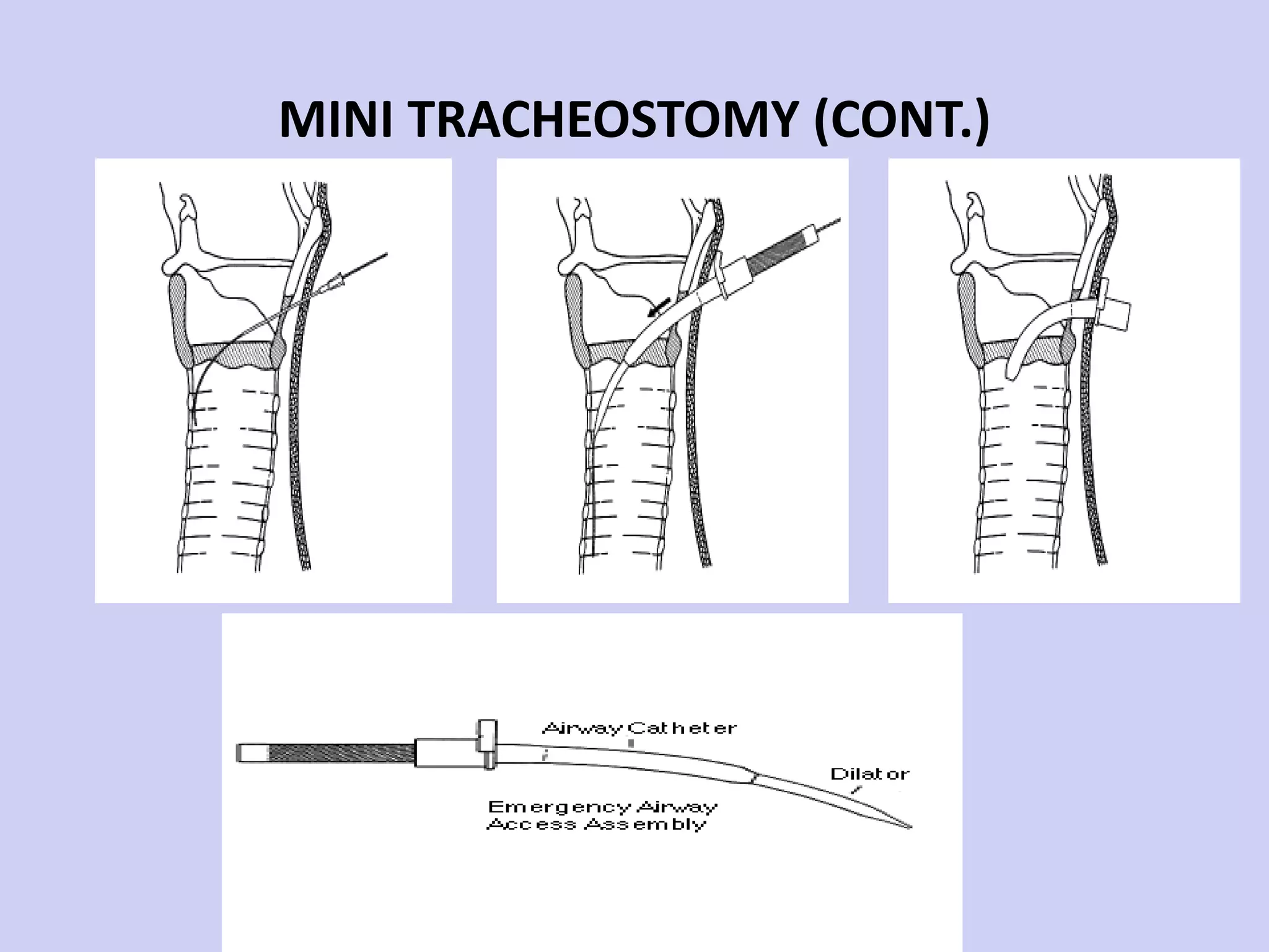MINI TRACHEOSTOMY (CONT.) 