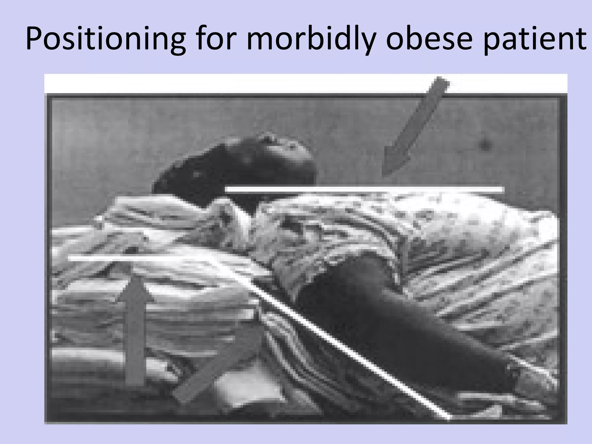 Positioning for morbidly obese patient 