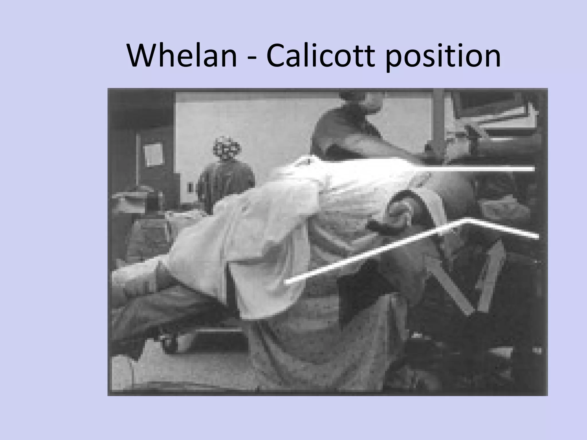 Whelan - Calicott position 