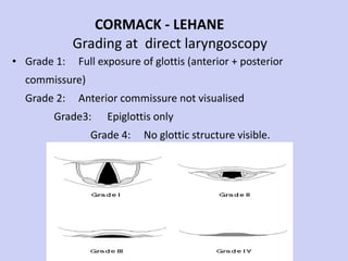CORMACK - LEHANE    Grading at  direct laryngoscopy Grade 1:  Full exposure of glottis (anterior + posterior commissure)  Grade 2:  Anterior commissure not visualised  Grade3:  Epiglottis only  Grade 4:  No glottic structure visible. 
