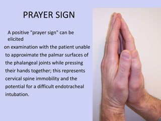 PRAYER SIGN A positive "prayer sign" can be elicited on examination with the patient unable to approximate the palmar surfaces of the phalangeal joints while pressing their hands together; this represents  cervical spine immobility and the  potential for a difficult endotracheal  intubation. 