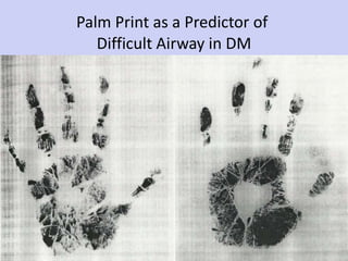 Palm Print as a Predictor of  Difficult Airway in DM 