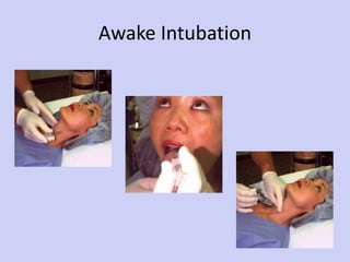 Awake Intubation 