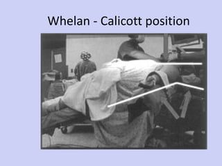 Whelan - Calicott position 