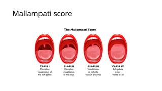 Mallampati score
 