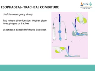 ESOPHAGEAL- TRACHEAL COMBITUBE
Useful as emergency airway
Two lumens allow function whether place
in esophagus or trachea
Esophageal balloon minimizes aspiration
 