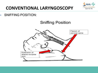  SNIFFING POSITION:
CONVENTIONAL LARYNGOSCOPY
 