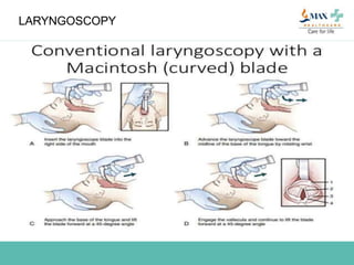 LARYNGOSCOPY:
 