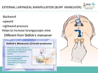EXTERNAL LARYNGEAL MANIPULATION (BURP MANEUVER):
--
-Backward
-upward
-rightward pressure
Helps to increase laryngoscopic view.
Different from Sellick’s manuever
 