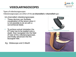 VIDEOLARYNGOSCOPES
Un-channelled videolaryngoscopes
 These devices can facilitate
visualization of the larynx when it
is not possible to do so with a
conventional blade.
 To achieve actual intubation the
ET tube has to be loaded onto a
stylet, then navigated into the field
of view of the videolaryngoscope,
and finally advanced into the
laryngeal inlet.
Eg: Glidescope and C-Mac®
Types of videolaryngoscopes
Videolaryngoscopes are either of the un-channelled or channelled type:
 