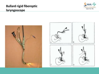 Bullard rigid fiberoptic
laryngoscope
 