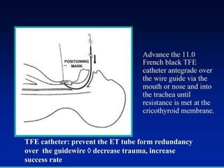 TFE catheter: prevent the ET tube form redundancy
over the guidewire  decrease trauma, increase
success rate
 
